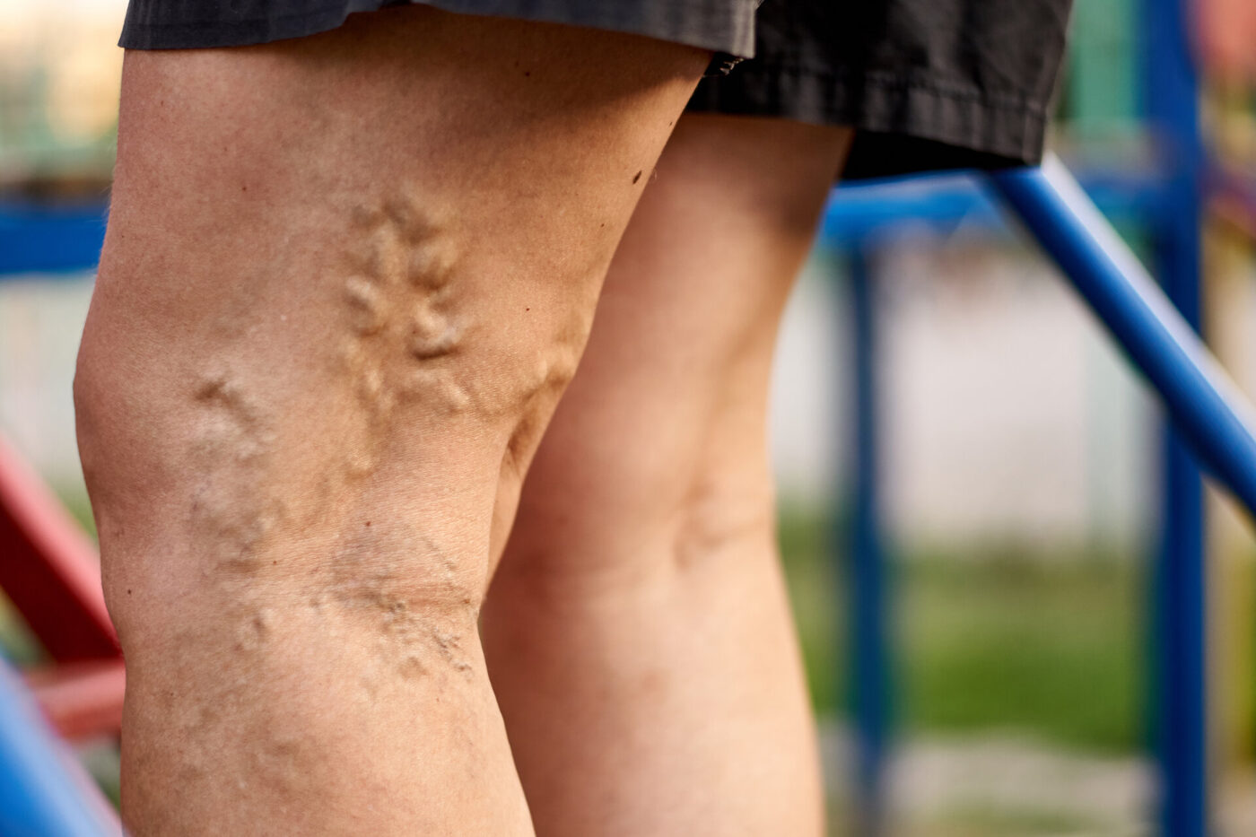 Close-up of varicose veins on legs
